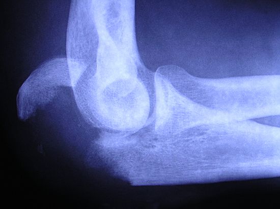 fractured right olecranon (tip of the ulna, the boniest part of elbow to which the tricep attaches)
