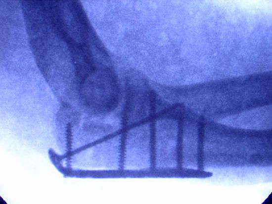 after the repair: 1 long, 5 shorter screws through plate